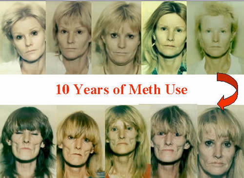 Meth User Pictures